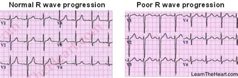 prwp ecg|Iba pa.
